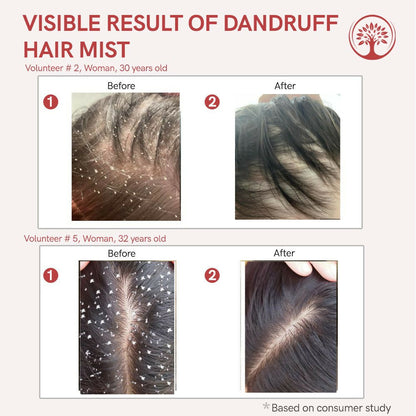 Ivory Natural Dandruff Hair Mist For Flake-Free Confidence And Silky Smooth Hair