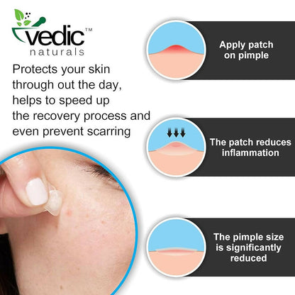 Vedic Naturals Acne Pimple Patches For Face & Skin Treatment